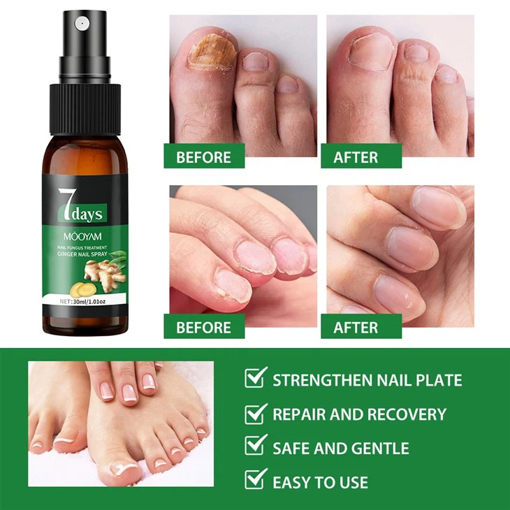 MOOYAM 7 Days Nail Fungus Treatment – Ginger Infused Nail Spray For Fast Relief