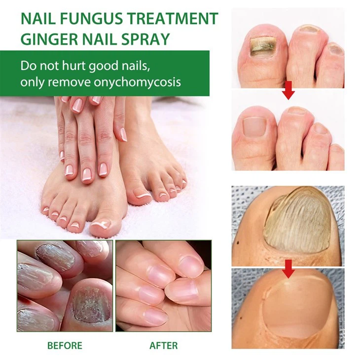 MOOYAM 7 Days Nail Fungus Treatment – Ginger Infused Nail Spray For Fast Relief